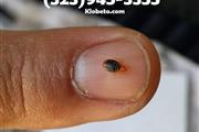 BED BUGS - PEST CONTROL 24/7 thumbnail
