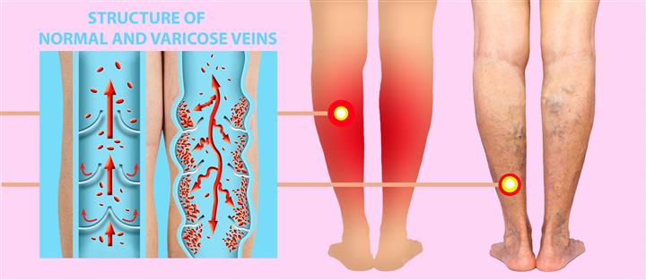 Varicose Vein, Ulcer & Wound image 1