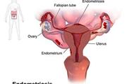 Endometriosis specialists thumbnail