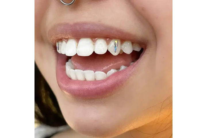 Blanqueo Dental 50$ image 4