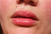 Rellenos de labios thumbnail