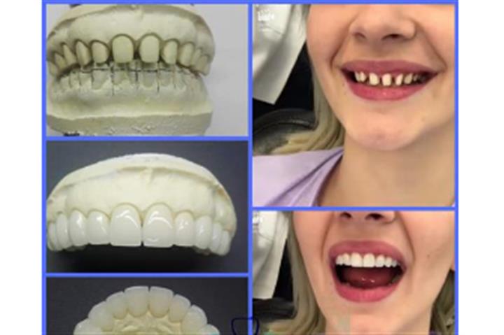 Prótesis dental a domicilio image 2