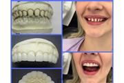 Prótesis dental a domicilio thumbnail