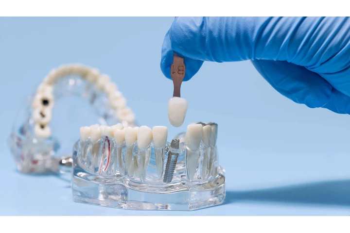 Best Dentist for Dental Implan image 2