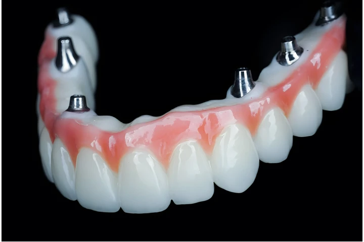 Whole Mouth Dental Implants image 2
