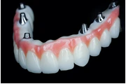 Whole Mouth Dental Implants thumbnail