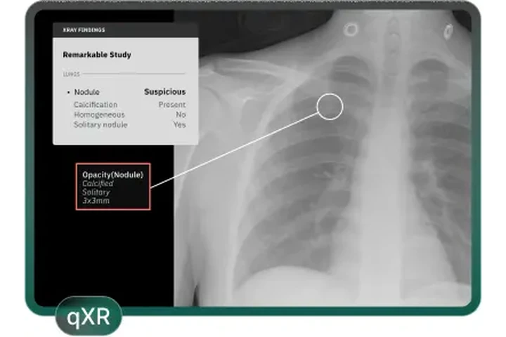 Qure.ai | Trusted AI Solutions image 1