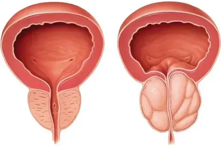 Prostate Enlargement & Cancer image 1