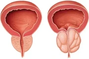 Prostate Enlargement & Cancer en Australia
