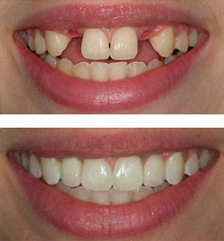 Placas dentales y protesis image 1