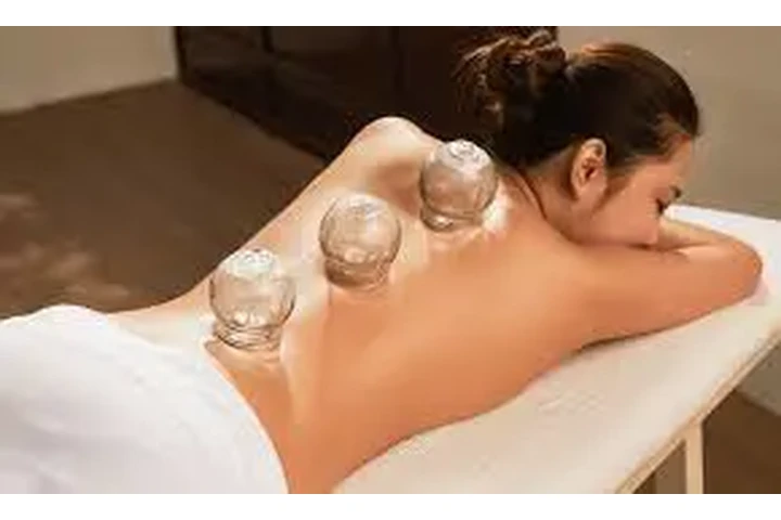 Cupping Therapy: Stress Relief image 1