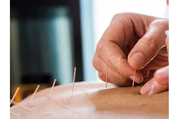 Acupuncture Toronto image 2