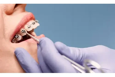 Implantes dentales desde $1999 en San Bernardino