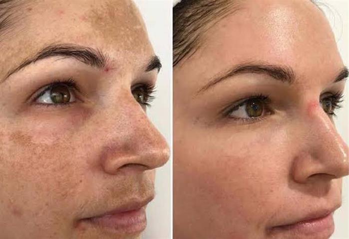 REJUVENE FACIAL MANCHAS  ACNE image 1