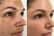 REJUVENE FACIAL MANCHAS  ACNE en Los Angeles