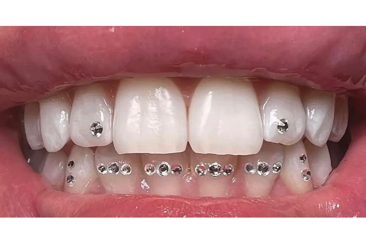 Blanqueamiento Dental $50 dls image 7