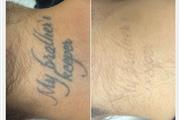 Eliminación de tatuajes en Miami