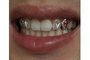 Blanqueo Dental 50$ en Riverside