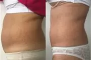 LIPO MASAJE MOLDEA TU CUERPO en Los Angeles