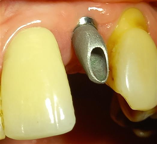 IMPLANTES DENTALES NACIONALES image 2