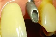 IMPLANTES DENTALES NACIONALES thumbnail