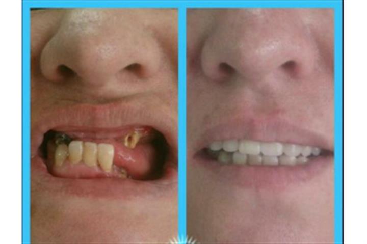 Prótesis dental a domicilio image 1