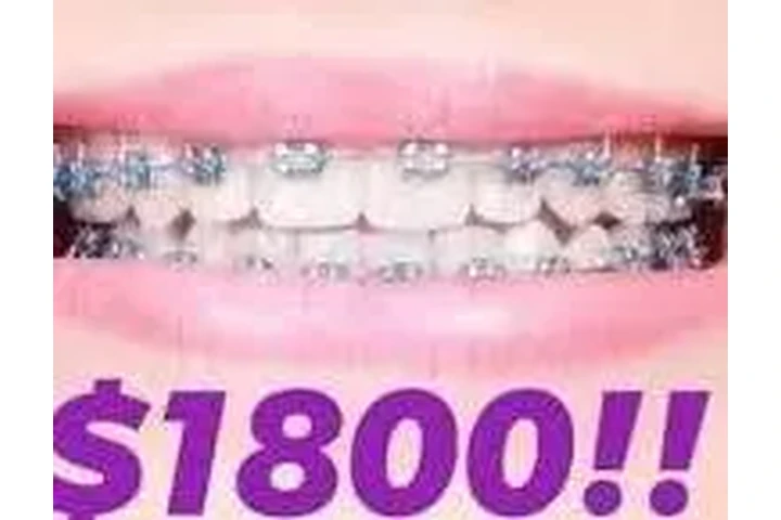 TRATAMIENTO DE BRACKETS image 1