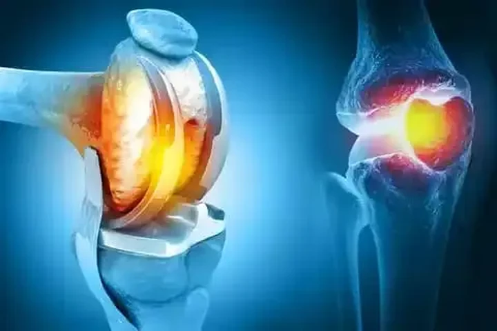 Knee replacement treatment image 1