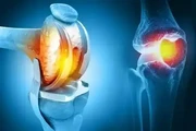 Knee replacement treatment en Australia
