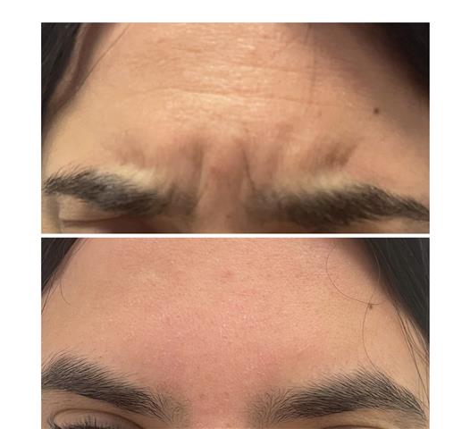 Rejuvenece tu rostro con botox image 5