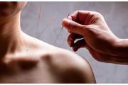 Acupuncture Treatment Sheppard en Toronto