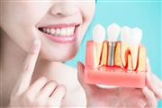 Affordable dental implants en Fort Worth