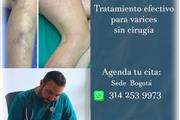 TrataVarices Dr.MiguelMonroy en Bogota