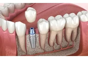 Dentista económico en Lynwood thumbnail
