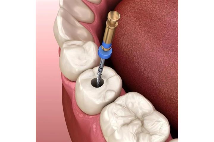 Implantes dentales desde $999 image 3