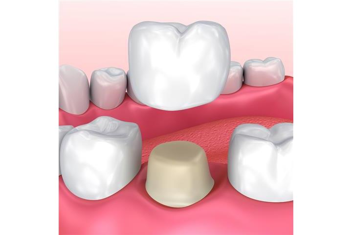 Implantes Dentales image 4