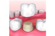 Implantes Dentales thumbnail