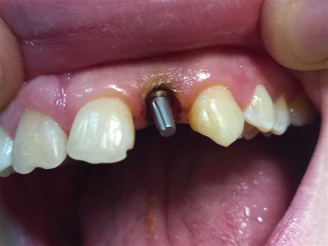 IMPLANTES DENTALES NACIONALES image 1