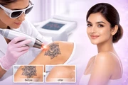 Safe and Advanced Laser Tattoo en New York