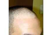 ¿ESTÁS PERDIENDO EL CABELLO? thumbnail