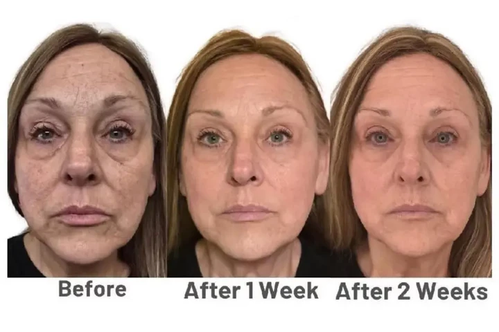 NEO FILLER ALTERNATIVA A BOTOX image 1