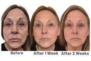 NEO FILLER ALTERNATIVA A BOTOX thumbnail