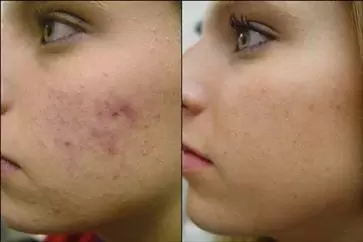 ACNE FACIAL LIMPIEZA PRODUNDA image 1