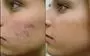 ACNE FACIAL LIMPIEZA PRODUNDA en Los Angeles