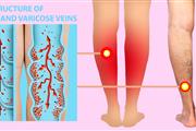 Varices, Úlceras y Heridas thumbnail