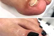 NAIL CALLOS UNEROS MANICURISTA thumbnail