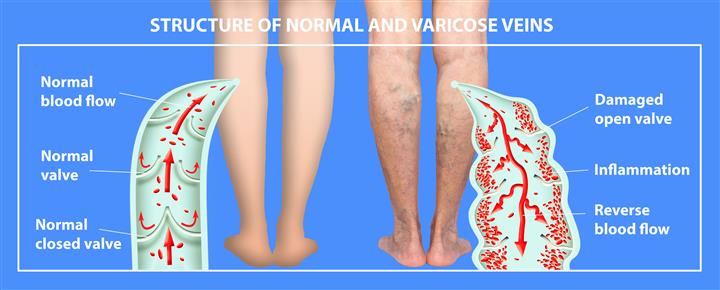 Varicose Veins, Ulcers, Wounds image 2