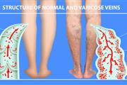 Varicose Veins, Ulcers, Wounds thumbnail