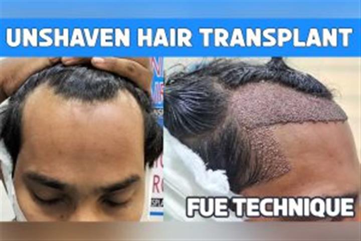 hair transplant image 5