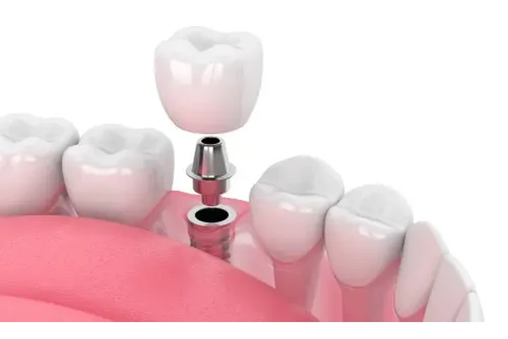 Emergencias Dentales image 1